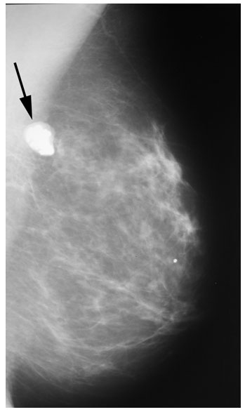 thyroid lobulated cyst